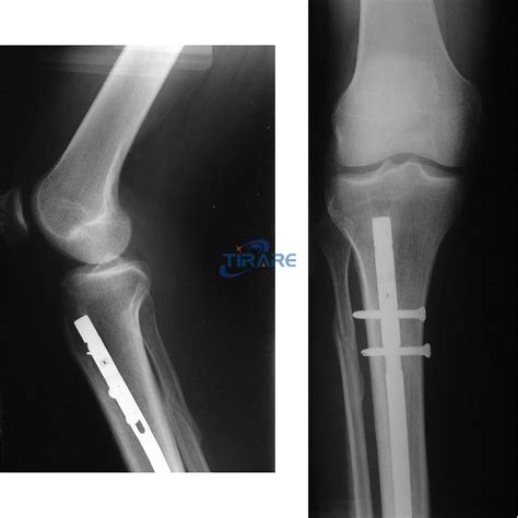 stable quality biocompatible 3mm to 20mm <strong>titanium rod</strong> in <strong>leg</strong> price, US $ 15 - 30 / Kilogram, China, FUTURE, TFBA. . Titanium rod in leg weight